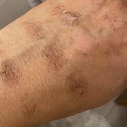 Ideal Image Allen Park - Burned hand caused by BBL services conducted at IDEAL IMAGE in Allen Park