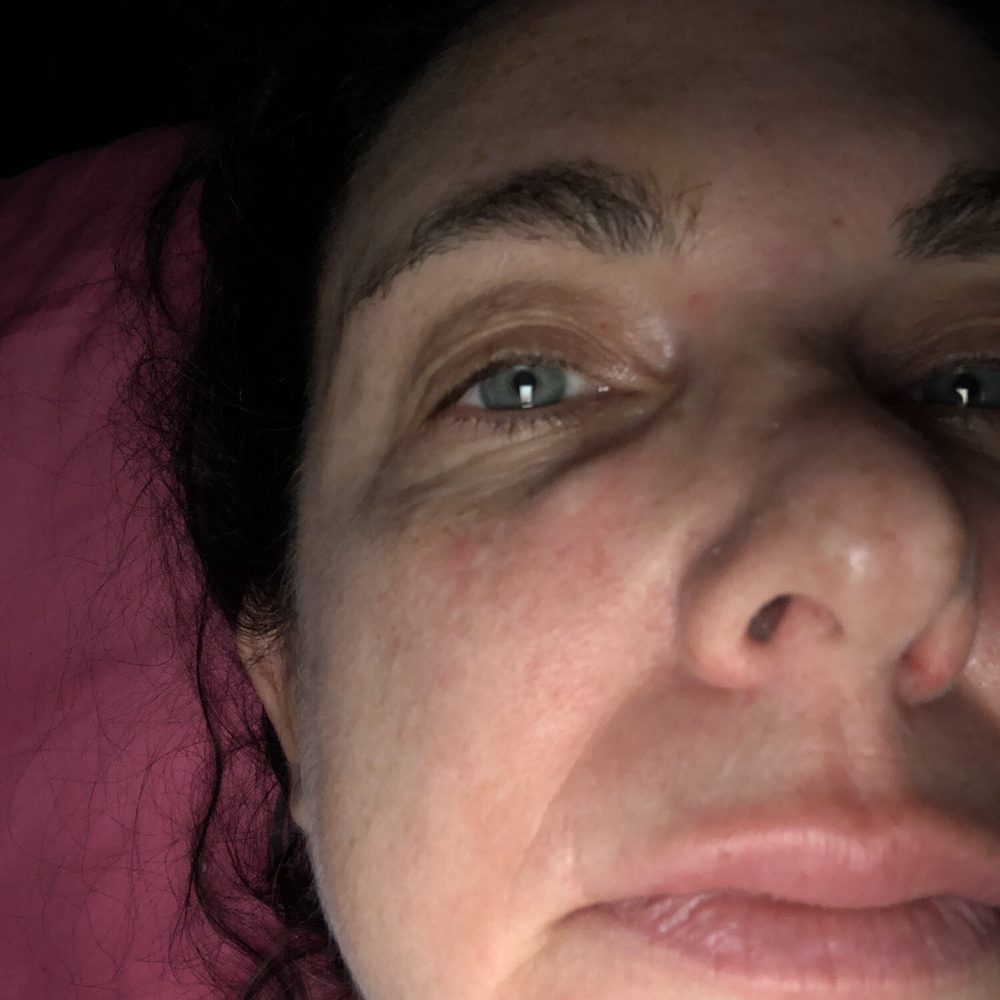 Bellafill lump courtesy of Ms. Cote Bellafill lump courtesy of Ms. Cote