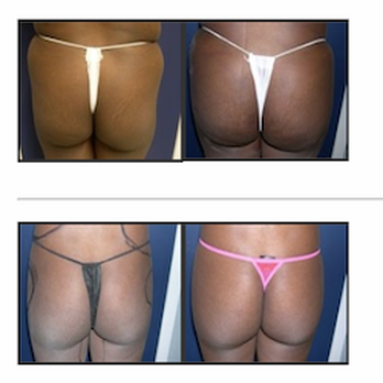 Park Plaza Plastic Surgery - Buttock Enlargement - Cosmetic Surgeons Near Me - New York, New York Park Plaza Plastic Surgery - Buttock Enlargement - Cosmetic Surgeons Near Me - New York, New York