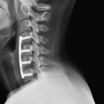 Advanced Physical Therapy - Multilevel Discectomy ,Titanium plate and screws - Physical Therapy Near Me - Gilbert, Arizona