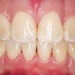 Pristine Orthodontics - Teeth after braces