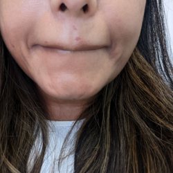 Blink Beauties - Burn marks on my upper lip.