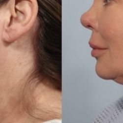 Robinson Facial Plastic Surgery - Left photo is the before photo.  Right is at 6 months.  Dr. Robinson told me that he could do nothing to correct what he caused.