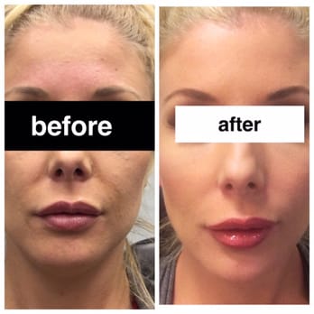 Venus Med Spa - Client after they have been to see us for fillers and Dysport! - Medical Spas Near Me - Clearwater, Florida Venus Med Spa - Client after they have been to see us for fillers and Dysport! - Medical Spas Near Me - Clearwater, Florida