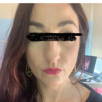 David C. Mabrie, MD - This is me and his office on June 29, 2021 getting my initial injection. This is what I look like before the injection. - Cosmetic Surgeons Near Me - San Francisco, California