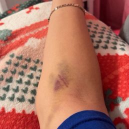 This photo is my arm a whole WEEK after getting the blood drawn for a sample that wasn't even taken right so couldn't be tested. This photo is my arm a whole WEEK after getting the blood drawn for a sample that wasn't even taken right so couldn't be tested.