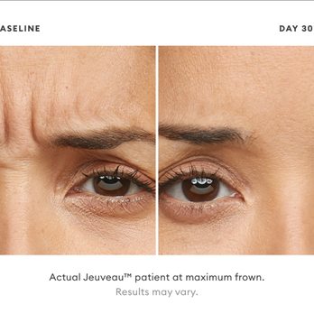 a La Mode Medspa - Actual Jeuveau patient at maximum frown. Results may vary. https://alamodemedspa.com/ - Aestheticians Near Me - Bakersfield, California