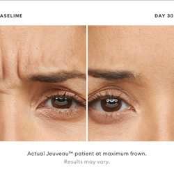 Actual Jeuveau patient at maximum frown. Results may vary.
https://alamodemedspa.com/