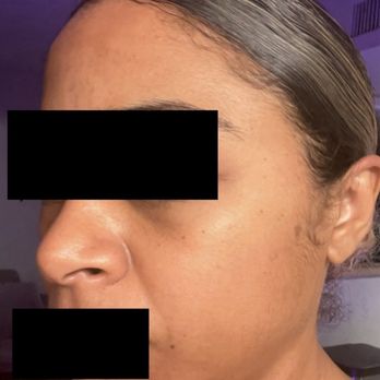 Epione - Malar Edema experienced after receiving dark circle treatment at Epione - Skin Care Near Me - Beverly Hills, California Epione - Malar Edema experienced after receiving dark circle treatment at Epione - Skin Care Near Me - Beverly Hills, California