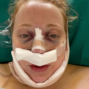 Vladimir Grigoryants, MD - Immediately after surgery in the recovery room - Cosmetic Surgeons Near Me - Glendale, California Vladimir Grigoryants, MD - Immediately after surgery in the recovery room - Cosmetic Surgeons Near Me - Glendale, California