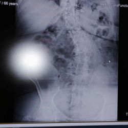 OmniSpine Pain Management - Frisco - X-ray of my back