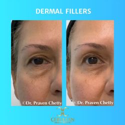 Cerulean Medical Institute - Dermal Fillers for tired eyes and the peri-orbital region by Dr. Praven Chetty in Kelowna BC, for a refreshed youthful looking appearance.