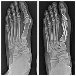 Dr. James Chung - Minimally invasive bunion correction