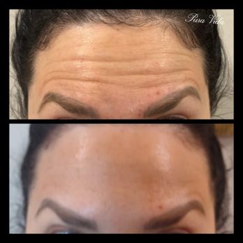 Pura Vida Esthetiques - Get your Botox done and look happier! - Teeth Whitening Near Me - Cedar Park, Texas Pura Vida Esthetiques - Get your Botox done and look happier! - Teeth Whitening Near Me - Cedar Park, Texas