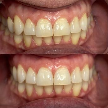 Smiletique - Me - before & after - Teeth Whitening Near Me - Burbank, California Smiletique - Me - before & after - Teeth Whitening Near Me - Burbank, California