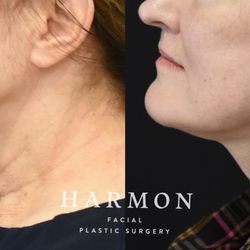 Harmon Facial Plastic Surgery