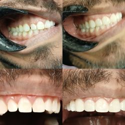 JK Family Dental - Same day results without shaving down teeth