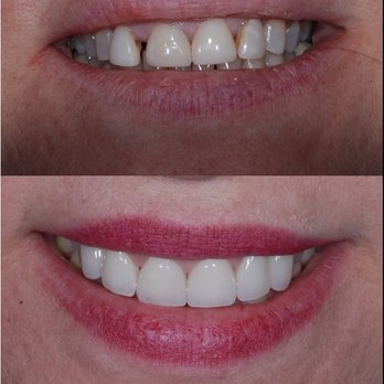 Genuine Family Dentistry - Before and After - Cosmetic Dentists Near Me - Orange, California Genuine Family Dentistry - Before and After - Cosmetic Dentists Near Me - Orange, California