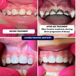 Lovebee Pediatric Dentistry - SDF (non-invasive treatment to slow down cavities).  White Crowns (final restoration).  Lip Tie Procedure.