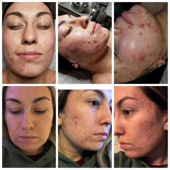 Elemental Aesthetics - Top: Before Deep cleansing facial and Jessner Peel
Bottom: One week later. Actual client, unretouched photos. - Skin Care Near Me - Mahopac, New York Elemental Aesthetics - Top: Before Deep cleansing facial and Jessner Peel
Bottom: One week later. Actual client, unretouched photos. - Skin Care Near Me - Mahopac, New York
