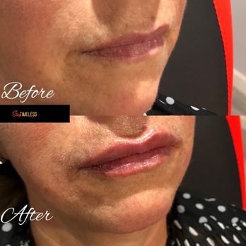 Stay Timeless On The Go - Nice + hydrated, first time with dermal filler, using Juvéderm Ultra XC (before + immediately after) - Medical Spas Near Me Stay Timeless On The Go - Nice + hydrated, first time with dermal filler, using Juvéderm Ultra XC (before + immediately after) - Medical Spas Near Me