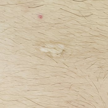 Schweiger Dermatology Group - The round 1/4" scar left from the mole removal. No scarring advice was given. - Dermatologists Near Me - New York, New York Schweiger Dermatology Group - The round 1/4" scar left from the mole removal. No scarring advice was given. - Dermatologists Near Me - New York, New York