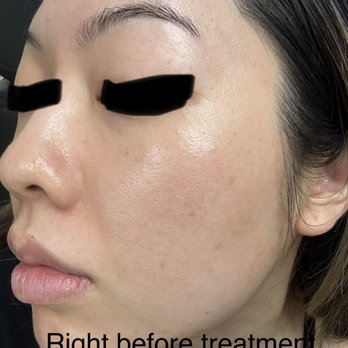 NakedMD - This was the good side of my skin. I wish I never did the micro-needling... - Medical Spas Near Me - Anaheim, California