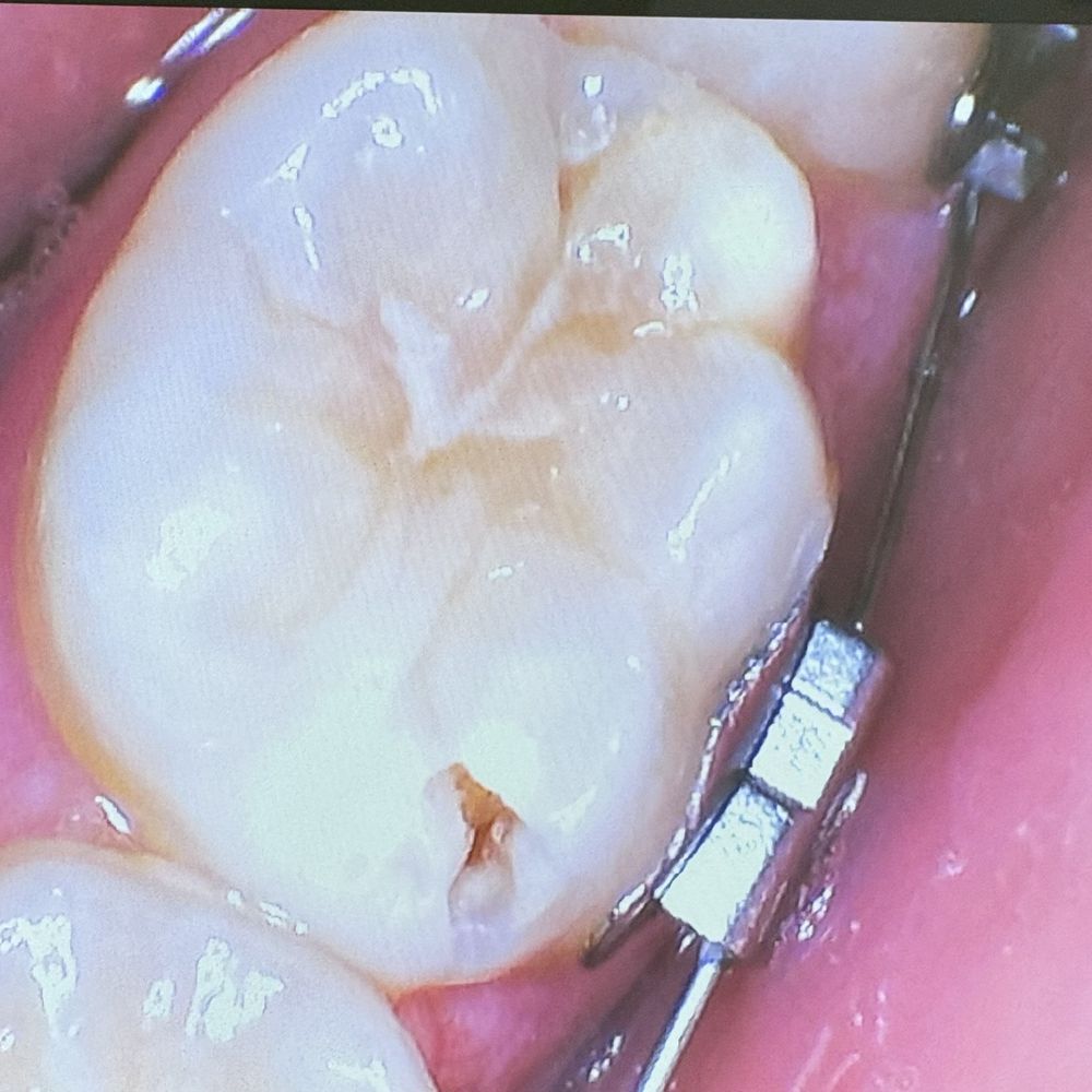 Growing Grins - A very evident cavity that was missed at growing grins (Gilbert) - Pediatric Dentists Near Me - Gilbert, Arizona Growing Grins - A very evident cavity that was missed at growing grins (Gilbert) - Pediatric Dentists Near Me - Gilbert, Arizona