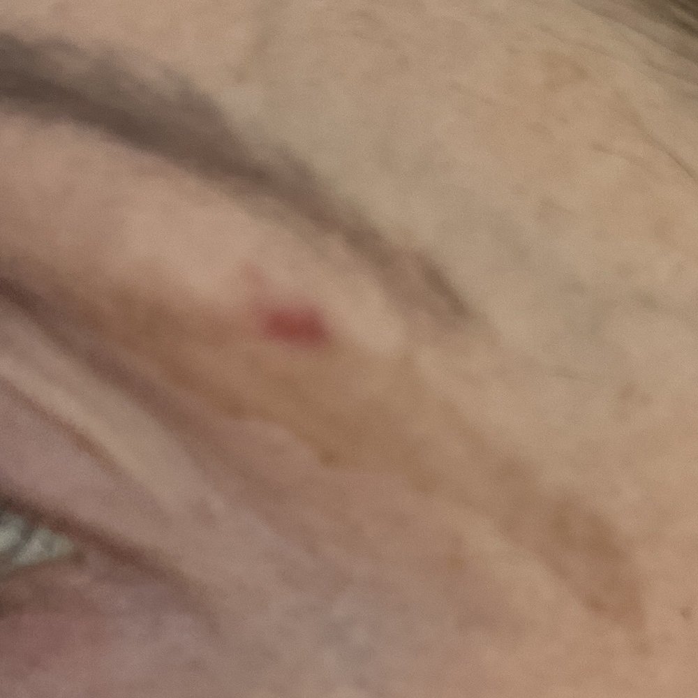 Few days after and still healing.