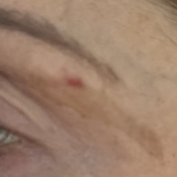 Few days after and still healing.