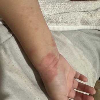 Children's Dermatology - Orange - Another painful spot of hers - Dermatologists Near Me - Orange, California