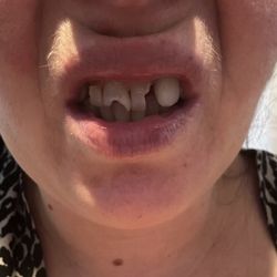 Heather Hurst, DMD - If your want your mouth looking like so, after paying  34,000$ CASH to fix!!! Than go to her!