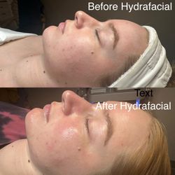Facial Expressions & More - Soft & Smooth Hydrafacial+Dermaplaning