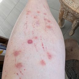 Bed bug bites Bed bug bites