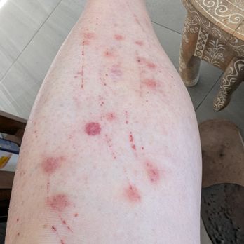 Hotel Zico - Bed bug bites - Hotels Near Me - Mountain View, California Hotel Zico - Bed bug bites - Hotels Near Me - Mountain View, California