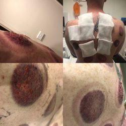 Lotus Chinese Massage - Completely negligent - this was the result of a cupping session on 08.05.2019 and the subsequent trip to emergency it required