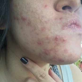 Skin By Beth Ann Warren - Before I saw beth my entire face looked like this. - Skin Care Near Me - Lake Oswego, Oregon Skin By Beth Ann Warren - Before I saw beth my entire face looked like this. - Skin Care Near Me - Lake Oswego, Oregon