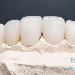 Tooth & Go Dental Clinic - Full mouth crowns/ full ceramic emax