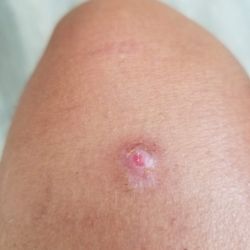 AllSkin Dermatology - After self treatment at home