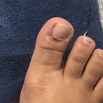 Magic Nails - My toe after the technician watered off the blood. - Nail Salons Near Me - Newport News, Virginia Magic Nails - My toe after the technician watered off the blood. - Nail Salons Near Me - Newport News, Virginia