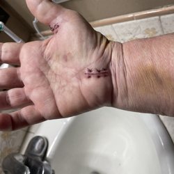 Sports Medicine Oregon - Right hand after wrap removed