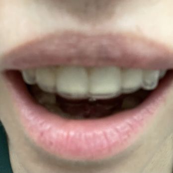 McCarthy Dental - They significantly shaved down my front teeth, which I had specifically told them I didn't want, - Cosmetic Dentists Near Me - New Bern, North Carolina