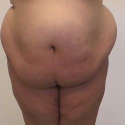 MyShape Lipo - Before