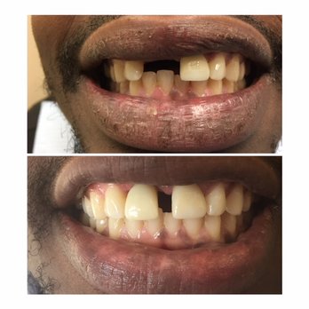 Smile Services DC - Before and after surgical implant placement after an accident. - Cosmetic Dentists Near Me - Washington, DC, District of Columbia Smile Services DC - Before and after surgical implant placement after an accident. - Cosmetic Dentists Near Me - Washington, DC, District of Columbia