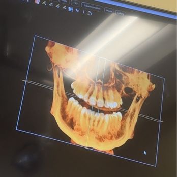 Fayetteville Smiles - Oral Surgery X ray to see mysterious "cyst" on my jaw. Cropped out my name so I remain anonymous. - General Dentistry Near Me - East Syracuse, New York Fayetteville Smiles - Oral Surgery X ray to see mysterious "cyst" on my jaw. Cropped out my name so I remain anonymous. - General Dentistry Near Me - East Syracuse, New York