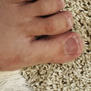 Jolie Nails - Bad bad pedicure aftermath - Nail Salons Near Me - Hutto, Texas