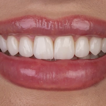 Epic Smile - Porcelain Veneer - General Dentistry Near Me - Newport Beach, California