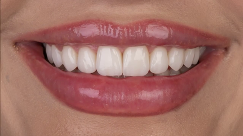 Porcelain Veneer - When a Dentist Trusts Us for Her Smile Makeover, It Means Everything! It’s always an honor when a fellow professional—a dentist—chooses us for their smile transformation. This patient, an experienced dentist herself, came to us seeking an enhanced, more attractive smile. Her old composite veneers had lost their luster, and she was ready for a change with porcelain veneers. We began with detailed photography and a 2D smile design, giving her and her husband (a businessman who knows quality) a glimpse of the final result. They both appreciated the chance to see the transformation before we even started. We then created a 3D model, allowing her to preview her new smile and make adjustments based on her personal preferences. With minimal preparation—less than 0.3 mm of her natural teeth—we applied 10 custom-designed porcelain veneers. The result? A stunning, natural, and radiant smile, tailored specifically to her desires. When a dentist chooses us, it speaks to our expertise and trustworthiness in the field. We deliver the best because our patients deserve nothing less.