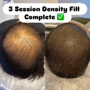 Smp Masters - Density Fill Scalp Micropigmentation - Hair Loss Centers Near Me - Merrick,, New York Smp Masters - Density Fill Scalp Micropigmentation - Hair Loss Centers Near Me - Merrick,, New York