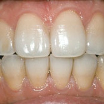 Ronald E Hawk, DDS - Before Tooth Whitening - Cosmetic Dentists Near Me - Boca Raton, Florida